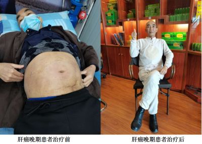 治疗各种癌症无效不收费广西百色杨忠雅医师